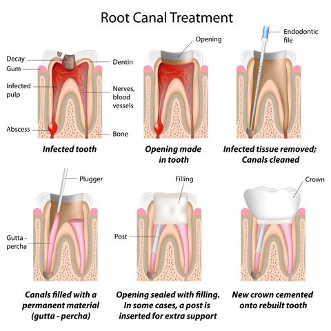 Leawood Family Dental - Endodontics