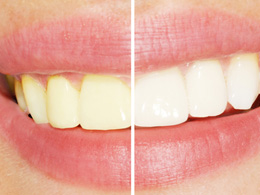 Leawood Family Dental - Teeth Whitening Procedures