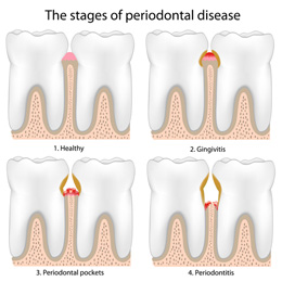 Leawood Family Dental - Periodontal (gum) Disease